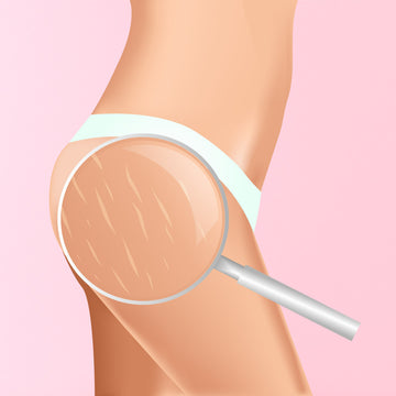 Comment faire disparaître les vergetures ?